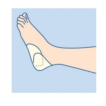 ΕΠΙΘΕΜΑ ΑΥΤΟΚΟΛΛΗΤΟ ΦΤΕΡΝΑΣ PHARMAFOAM CONCAVE 18Χ16.5CM